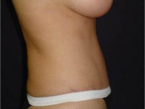 Tummy Tuck - Patient 7 -  After 3
