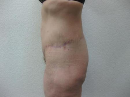 Body Lift - Patient 8 - After Image 7