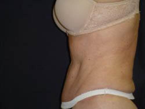Tummy Tuck - Patient 8 -  After 3
