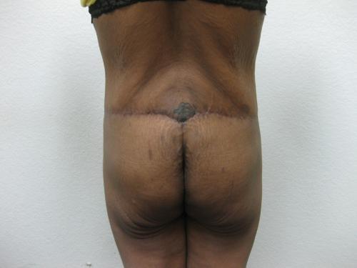 Body Lift - Patient 6 - After 2