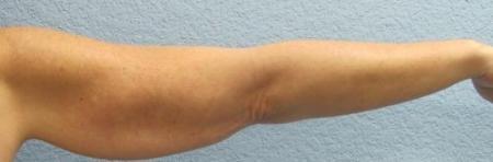 Arm Lift Surgery - Patient 3 - Before Image 4