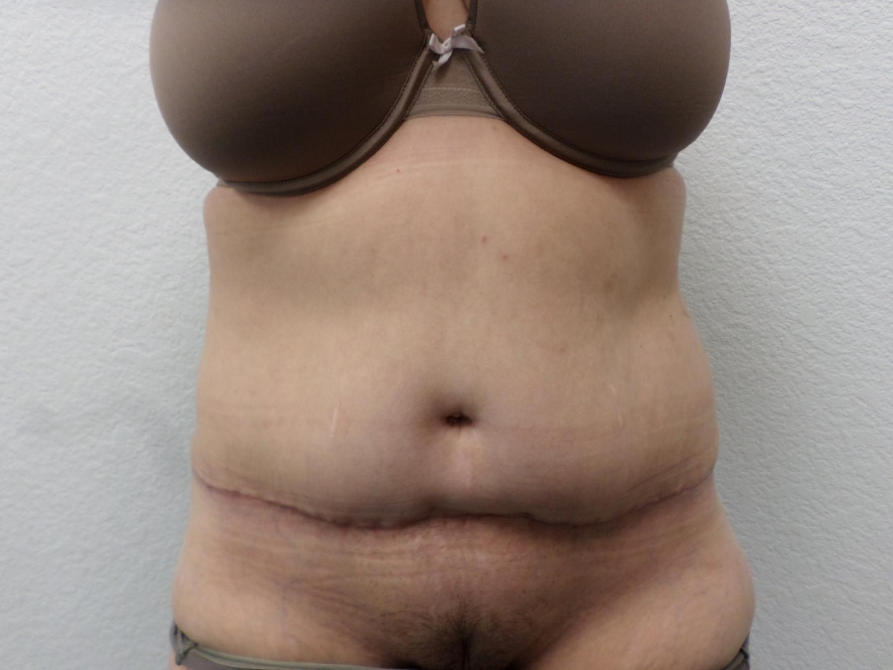Tummy Tuck: Patient 29 - After 1