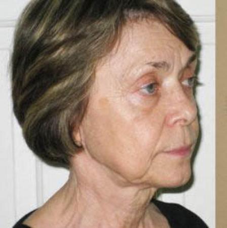 Facelift - Patient 2 - Before Image 5