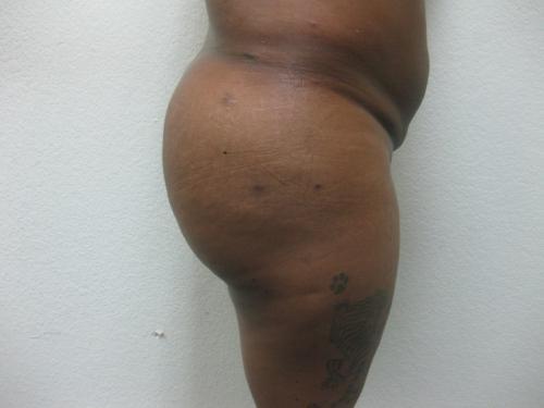 Brazilian Butt Lift - Patient 5 - After 5