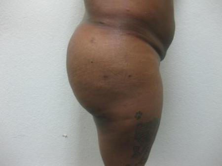Brazilian Butt Lift - Patient 5 - After Image 5