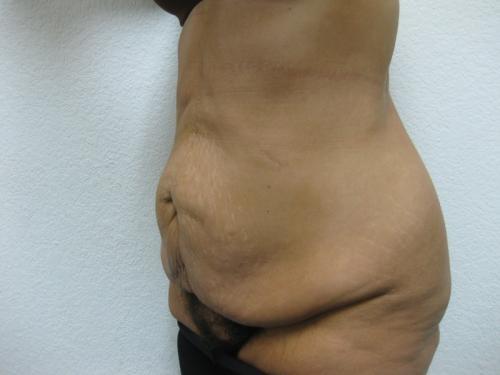 Patient 11 - Cosmetic Surgery After Massive Weight Loss - Before 2