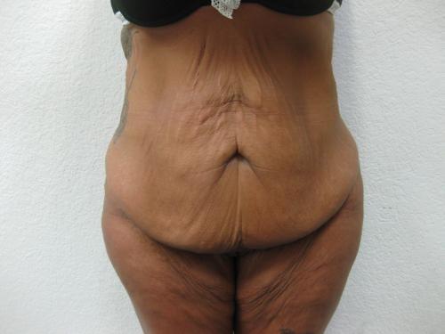 Patient 9 - Cosmetic Surgery After Massive Weight Loss - Before