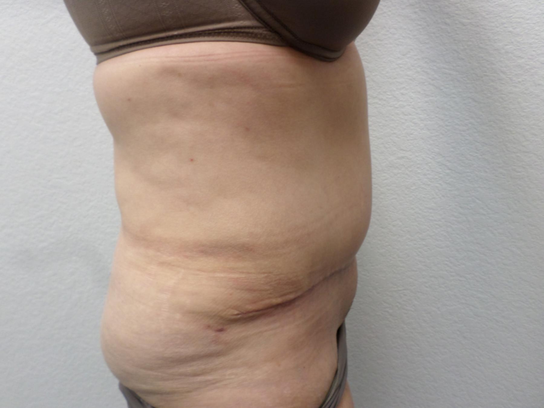 Tummy Tuck: Patient 29 - After 5