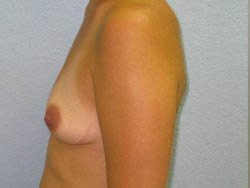 Breast Augmentation - Patient 6 - Before and After 3