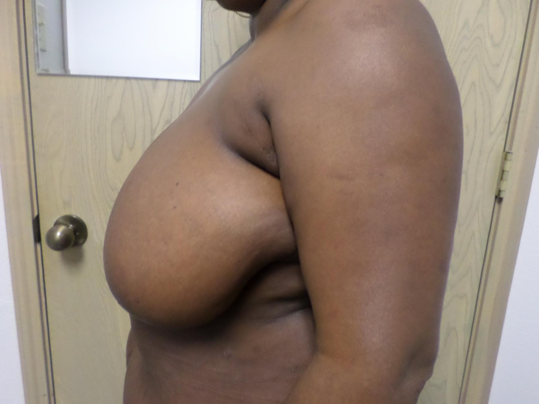 Breast Reduction: Patient 15 - Before 2