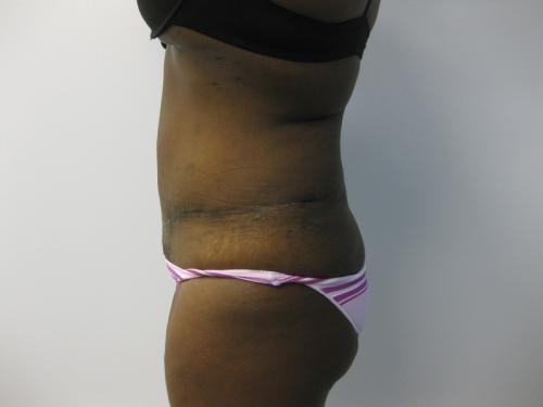 Patient 13 - Cosmetic Surgery After Massive Weight Loss -  After 3
