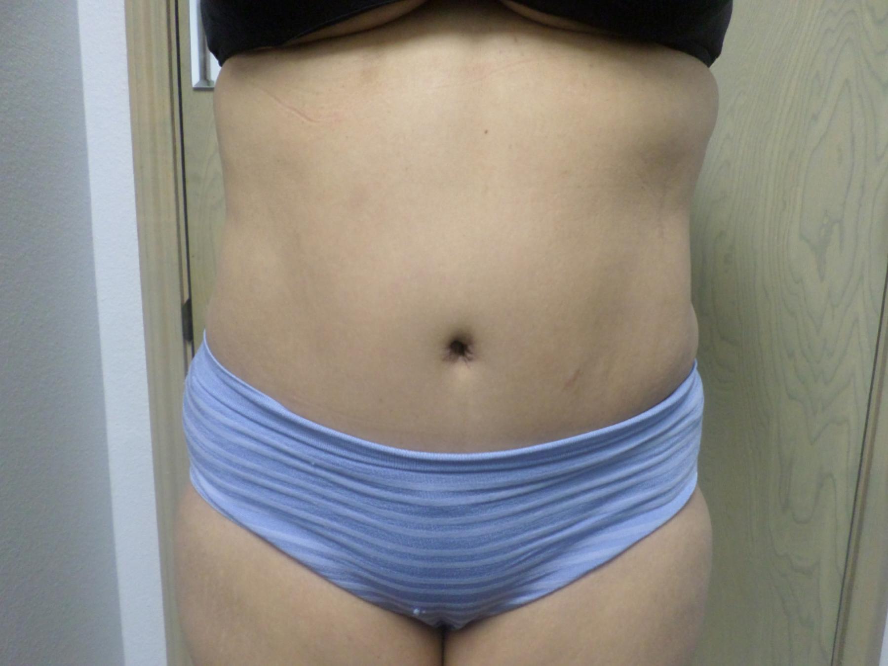 Liposuction: Patient 16 - After 1