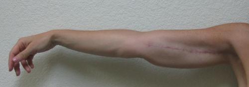 Arm Lift Surgery - Patient 3 -  After 2