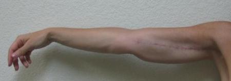Arm Lift Surgery - Patient 3 - After Image 2