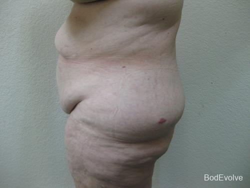 Patient 7 - Cosmetic Surgery After Massive Weight Loss - Before 3