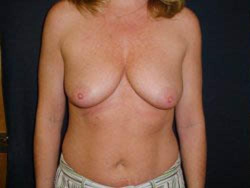 Breast Augmentation - Patient 18 - Before 1
