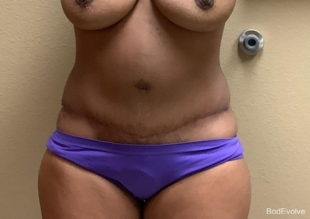 Tummy Tuck: Patient 6 - After  