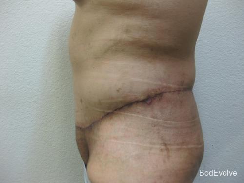 Body Lift - Patient 1 - After 3