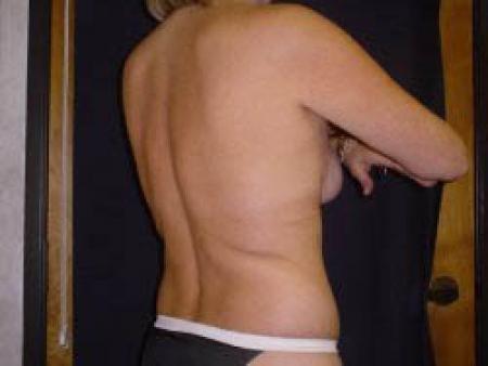 Liposuction - Patient 8 - Before Image 6