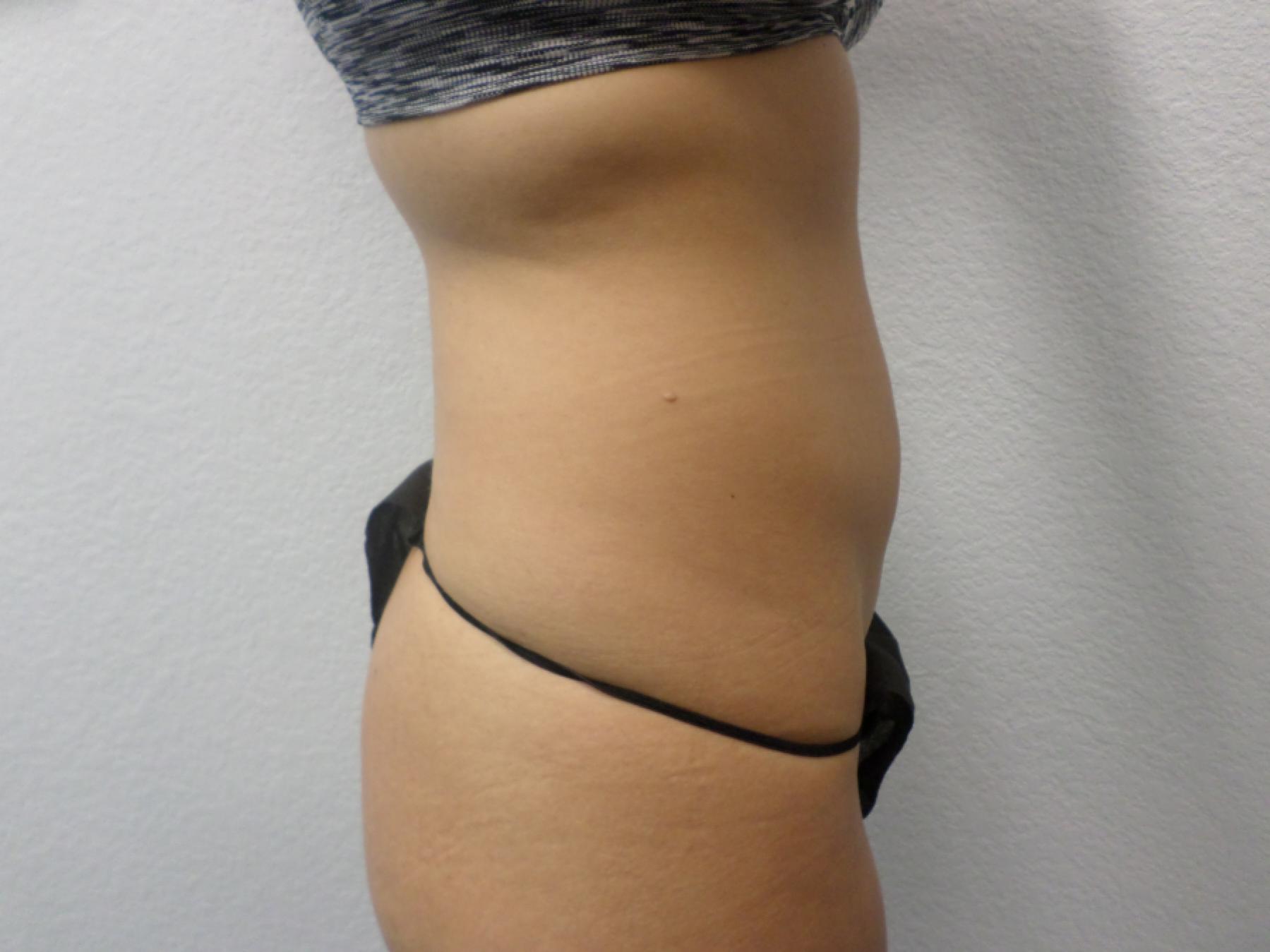 Liposuction: Patient 15 - Before 2