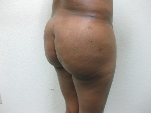 Brazilian Butt Lift - Patient 5 -  After 4