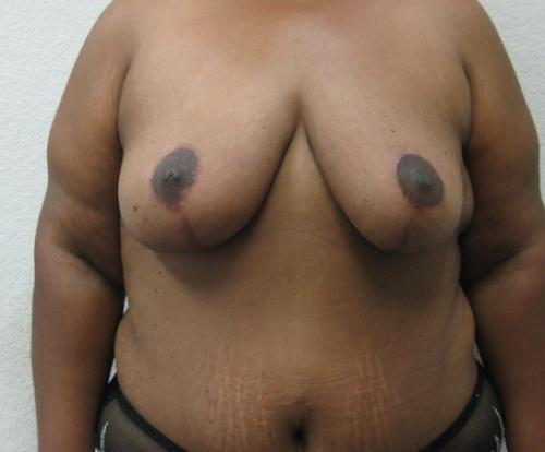Breast Reduction - Patient 6 - After 