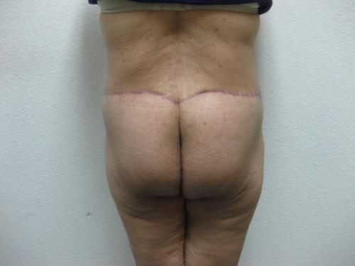 Patient 14 - Cosmetic Surgery After Massive Weight Loss -  After 4