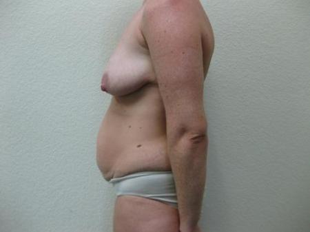 Mommy Makeover - Patient 3 - Before Image 3