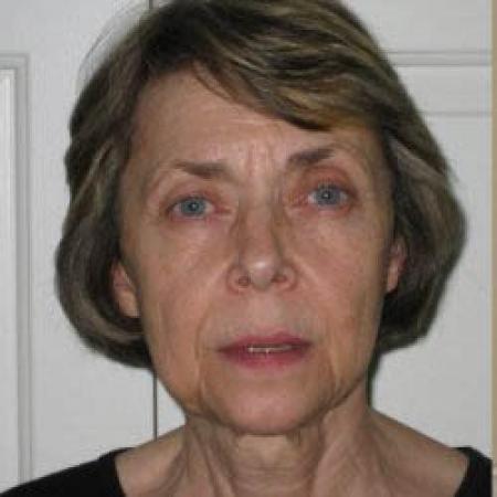 Facelift - Patient 2 - Before Image 4