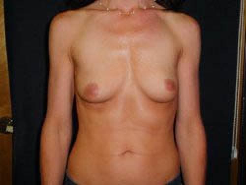 Breast Augmentation - Patient 7 - Before