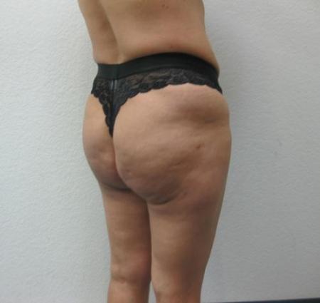 Brazilian Butt Lift - Patient 4 - After Image 2