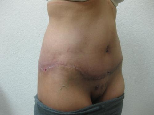 Patient 25 - Cosmetic Surgery After Massive Weight Loss -  After 8
