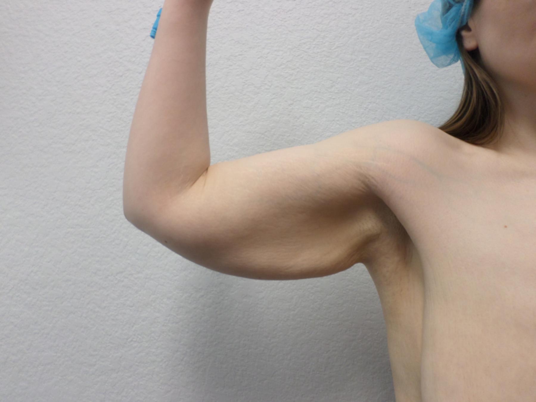 Arm Lift: Patient 8 - Before and After 4