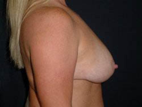 Breast Augmentation with Lift - Patient 6 - Before and After 3