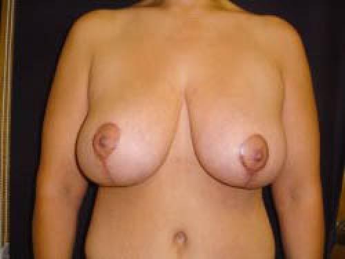 Breast Augmentation with Lift - Patient 9 - After 1