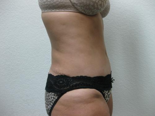 Tummy Tuck - Patient 4 -  After 6