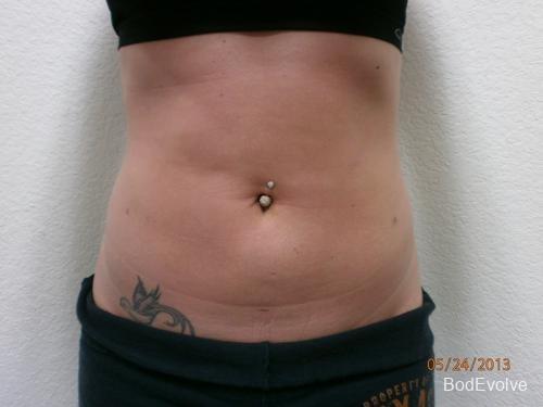 Liposuction - Patient 2 - After 