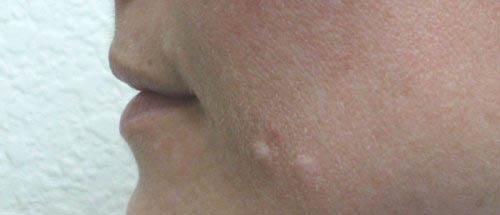 Lip Augmentation - Patient 1 - Before