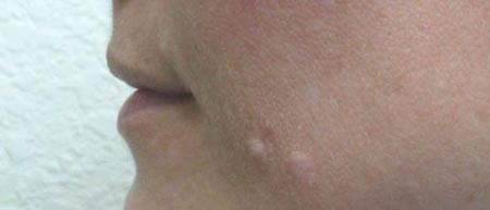 Lip Augmentation - Patient 1 - Before Image 1