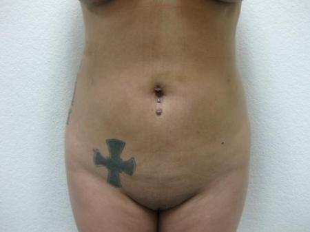 Brazilian Butt Lift - Patient 3 - After Image 2