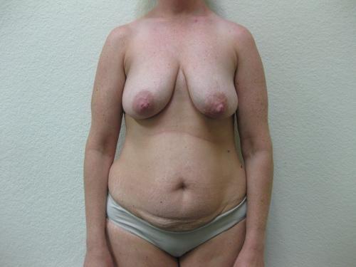 Tummy Tuck - Patient 13 - Before 1