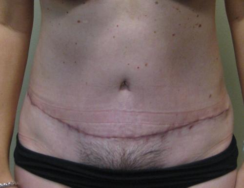 Tummy Tuck - Patient 6 -  After 1