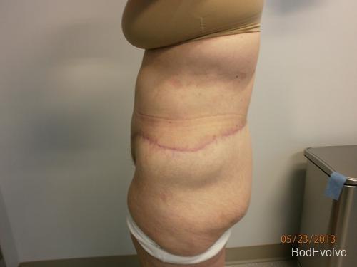 Patient 7 - Cosmetic Surgery After Massive Weight Loss -  After 3