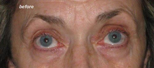Eyelid Lift - Before