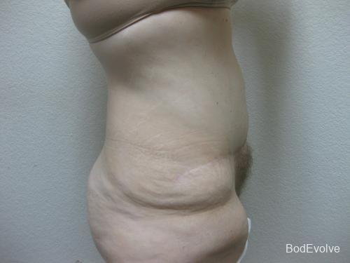 Patient 4 - Cosmetic Surgery After Massive Weight Loss -  After 5