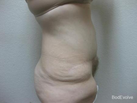 Patient 4 - Cosmetic Surgery After Massive Weight Loss - After Image 5