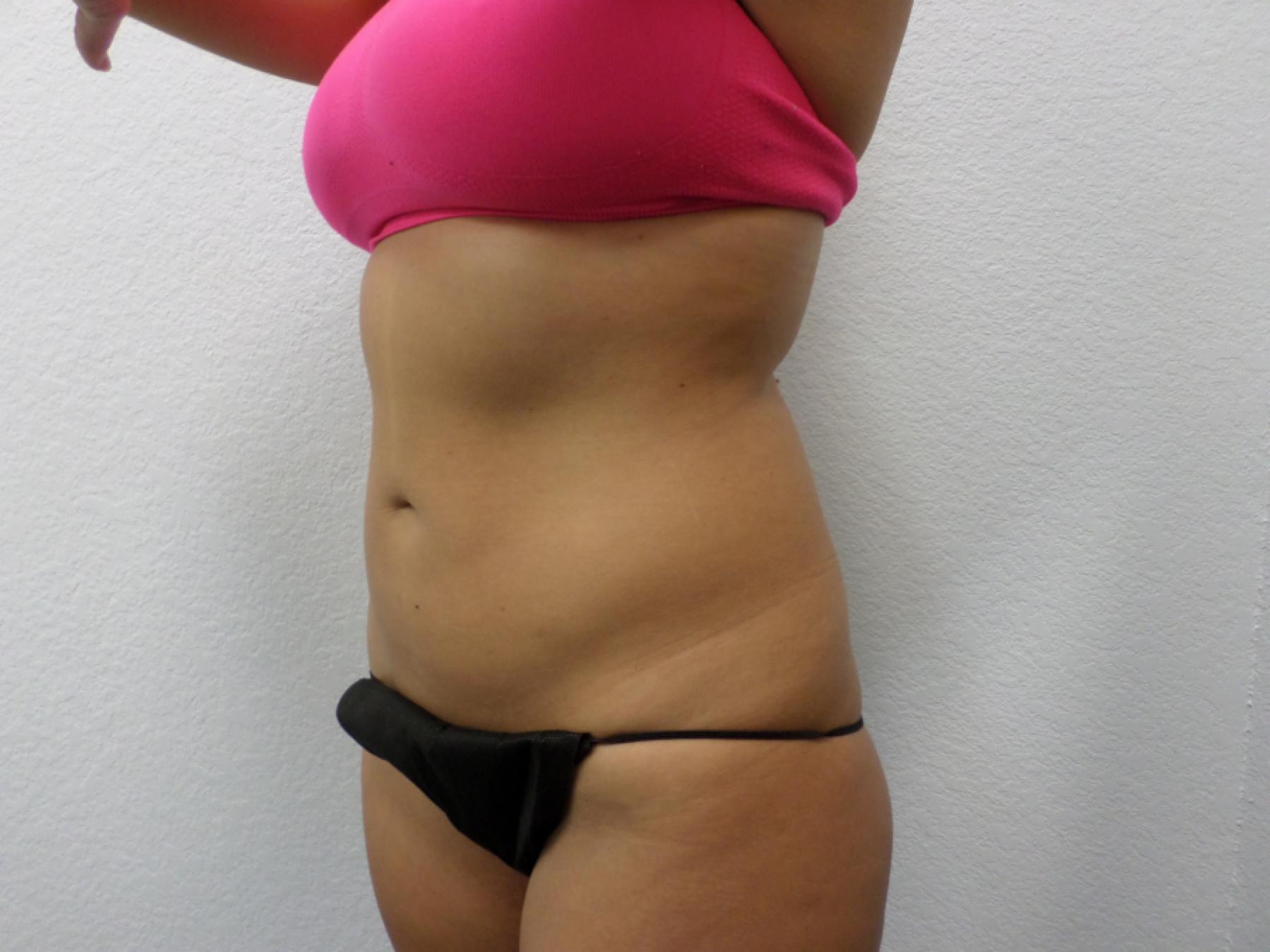 Liposuction: Patient 15 - After 3