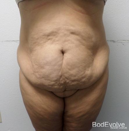 Tummy Tuck: Patient 12 - Before 1