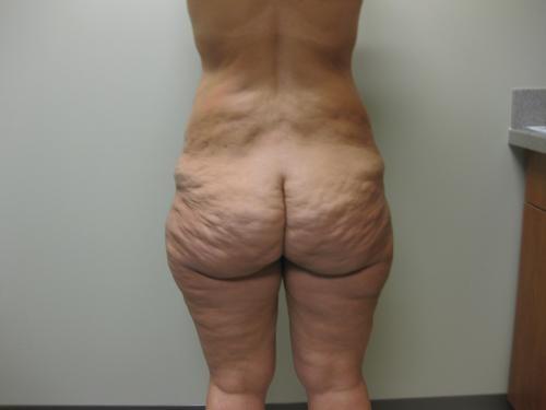 Patient 25 - Cosmetic Surgery After Massive Weight Loss - Before 5