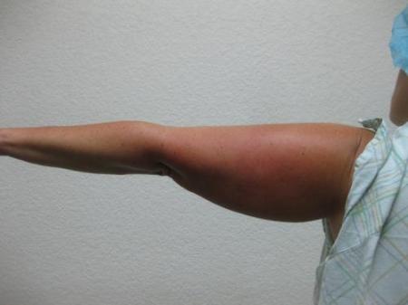 Liposuction - Patient 4 - Before Image 4